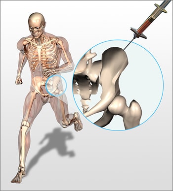 Bone Marrow Aspirate Location