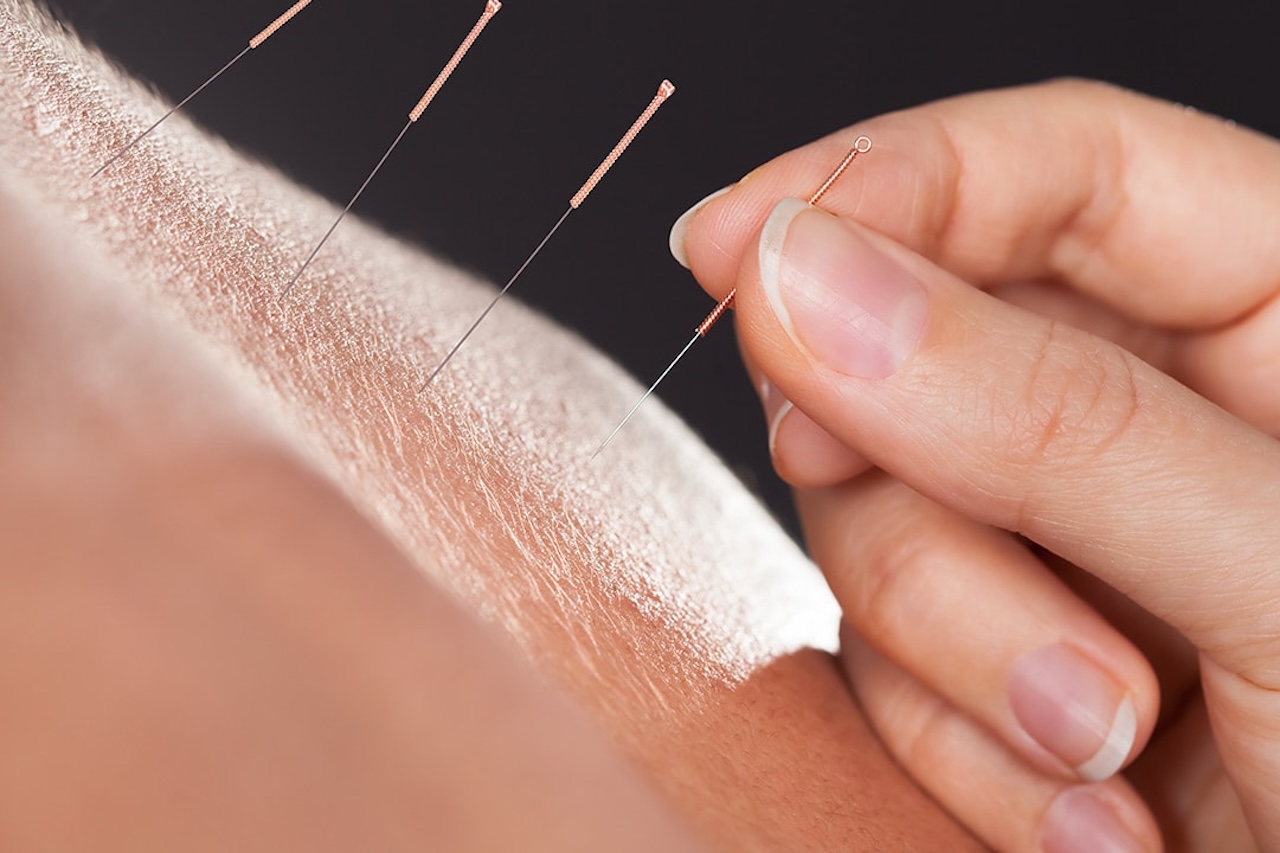 acupuncture